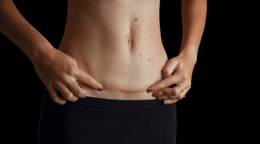scar after abdominoplasty